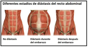 Estadios de diastasis del recto del abdomen