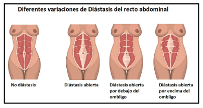 Diástasis abdominal Qué es y cómo prevenirla