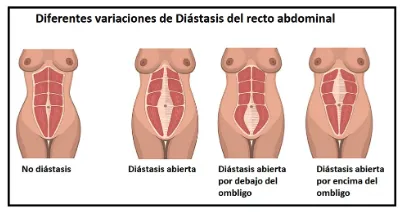 Tipos de diastasis