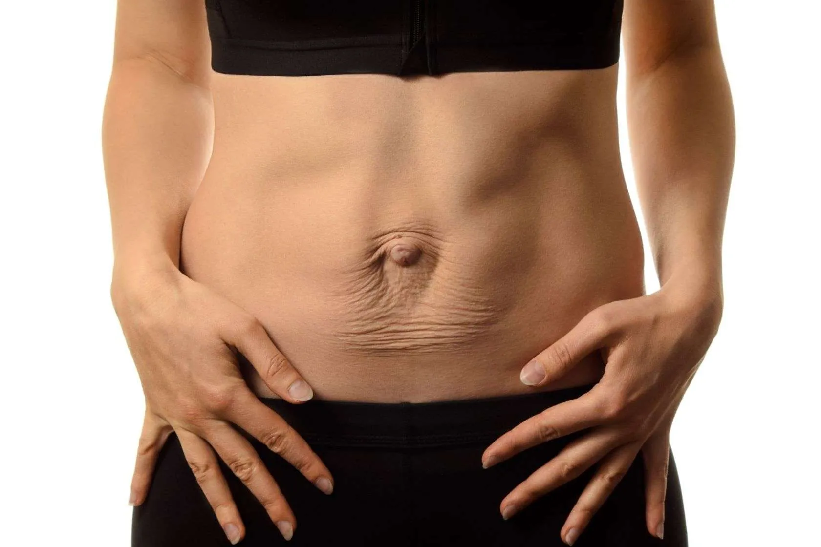 Diastasis abdominal